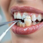 dent qui se casse carence